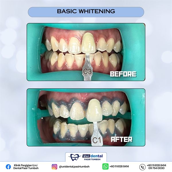 Sebelum dan selepas rawatan: Basic Whitening