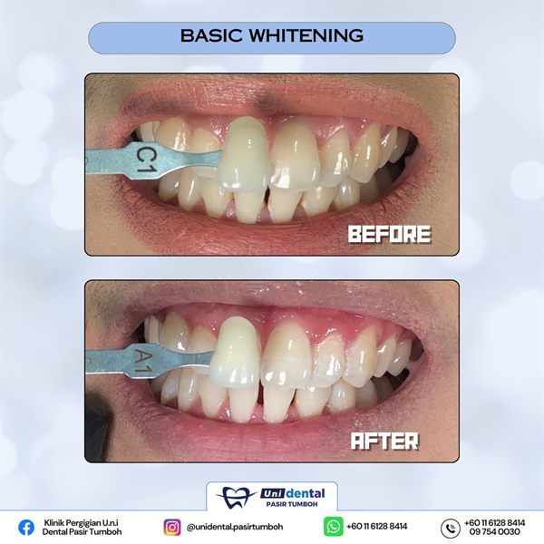 Sebelum dan selepas rawatan: Basic Whitening