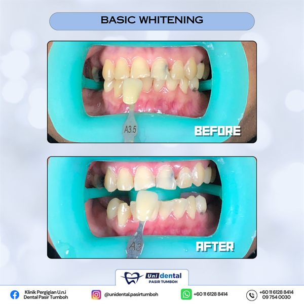 Sebelum dan selepas rawatan: Basic Whitening