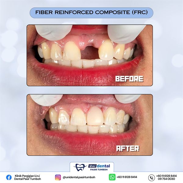 Sebelum dan selepas rawatan: Fiber Reinforced Composite (FRC)