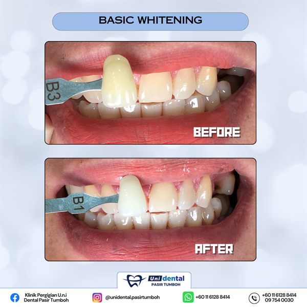 Sebelum dan selepas rawatan: Basic Whitening