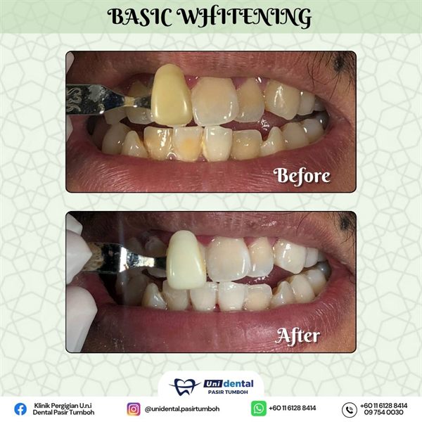 Sebelum dan selepas rawatan: Basic Whitening