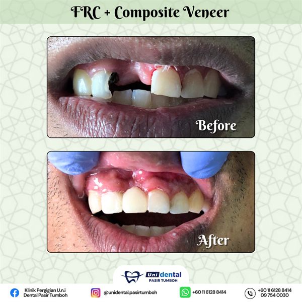 Sebelum dan selepas rawatan: FRC + Composite Veneer