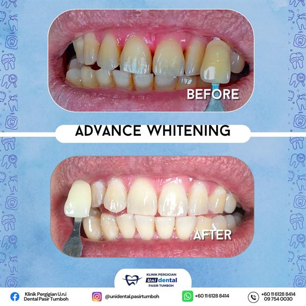 Sebelum dan selepas rawatan: Advance Whitening