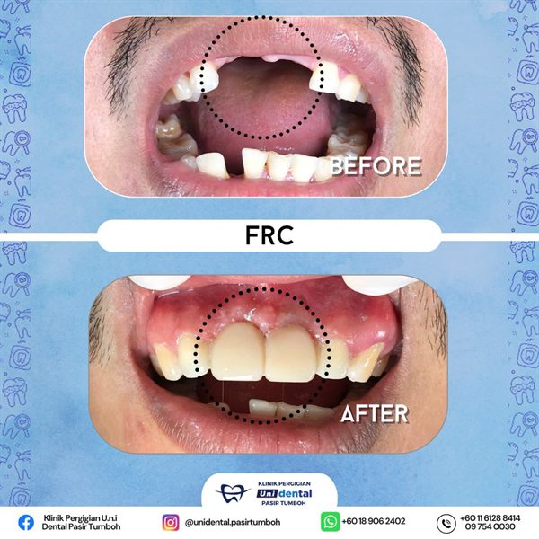 Sebelum dan selepas rawatan: FRC