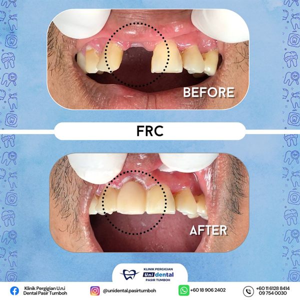 Sebelum dan selepas rawatan: FRC