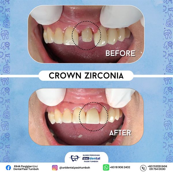 Sebelum dan selepas rawatan: Crown Zirconia