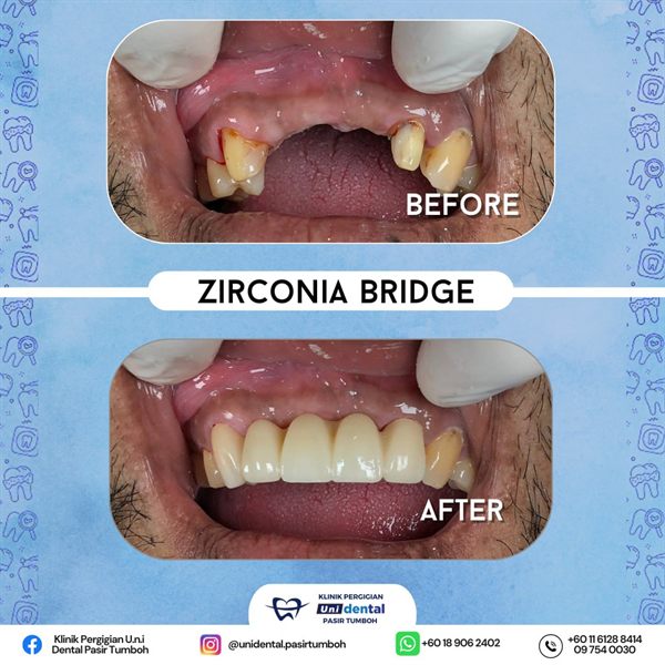 Sebelum dan selepas rawatan: Zirconia Bridge