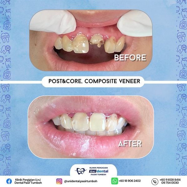 Sebelum dan selepas rawatan: Post & Core, Composite Veneer