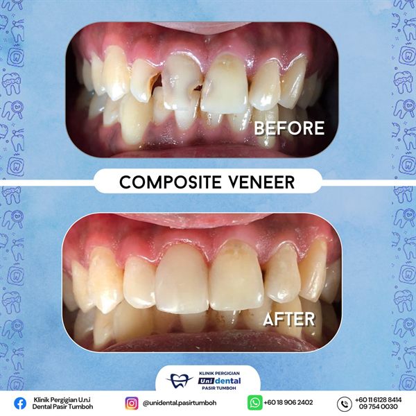Sebelum dan selepas rawatan: Composite Veneer